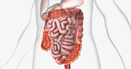 La enfermedad de Crohns es un tipo de enfermedad inflamatoria intestinal crónica. Renderizado 3D