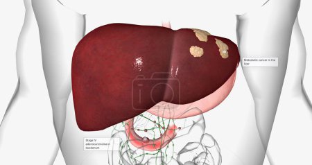 Photo for Stage IV adenocarcinoma in duodenum 3D rendering - Royalty Free Image