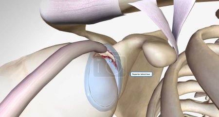 Photo for A superior labral tear is when a lesion is found in the upper portion for the labrum.3D rendering - Royalty Free Image