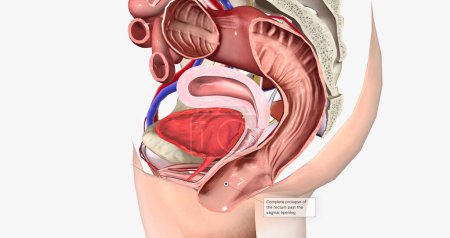 Foto de Complete prolapse of the rectum past the vaginal opening 3D rendering - Imagen libre de derechos