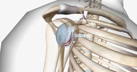 Photo for A Bankart lesion occurs as the result of a forward shoulder dislocation.3D rendering - Royalty Free Image