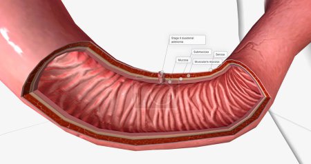 Photo for The Stage II duodenal adenoma 3D rendering - Royalty Free Image