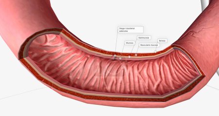 Photo for The Stage I duodenal adenoma 3D rendering - Royalty Free Image
