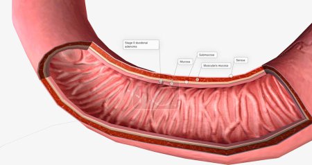 Photo for The Duodenal Carcinoma, Stage 0 3D rendering - Royalty Free Image