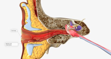Une infection de l'oreille externe, également appelée otite externe rendu 3D