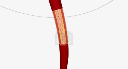 Téléchargez les photos : Vaisseau sanguin rétréci dans les membres inférieurs L'intervention artérielle dans les membres inférieurs peut inclure une angioplastie, des endoprothèses ou une athérectomie. rendu 3D - en image libre de droit