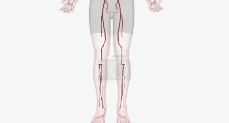 Foto de Las intervenciones arteriales de las extremidades inferiores son procedimientos diseñados para restaurar el flujo sanguíneo a las piernas y los pies. Renderizado 3D - Imagen libre de derechos