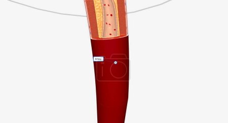 Téléchargez les photos : Vaisseau sanguin rétréci dans les membres inférieurs L'intervention artérielle dans les membres inférieurs peut inclure une angioplastie, des endoprothèses ou une athérectomie. rendu 3D - en image libre de droit