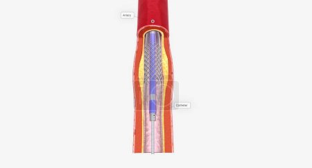 Foto de La angioplastia es un procedimiento mínimamente invasivo que utiliza un catéter con una punta de globo para expandir la arteria bloqueada. Renderizado 3D - Imagen libre de derechos