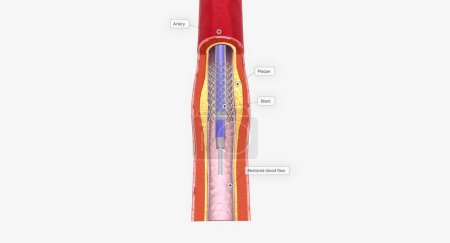 Téléchargez les photos : Une endoprothèse peut être mise en place pour prévenir le blocage à l'avenir. rendu 3D - en image libre de droit