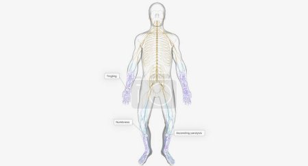 Photo for Guillain Barre syndrome is a rare disorder in which your body's immune system attacks your nerves. 3D rendering - Royalty Free Image