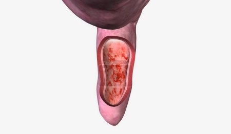 Téléchargez les photos : La proctite est une inflammation du rectum qui provoque de l'inconfort, des saignements, occasionnellement, un écoulement de mucus ou de pus. rendu 3D - en image libre de droit