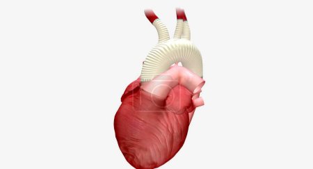 Un injerto sintético es un tubo artificial que permite que la sangre oxigenada fluya desde el corazón al resto del cuerpo. Renderizado 3D