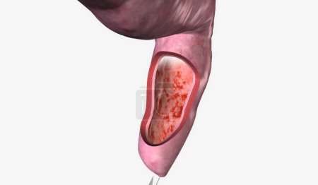 Téléchargez les photos : La proctite est une inflammation du rectum qui provoque de l'inconfort, des saignements, occasionnellement, un écoulement de mucus ou de pus. rendu 3D - en image libre de droit