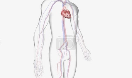 Téléchargez les photos : Le PIBA fournit de l'aide lors d'un choc cardiogénique, une affection grave qui survient lorsque le cœur n'est pas en mesure de pomper suffisamment de sang vers le reste du corps. Rendu 3D - en image libre de droit