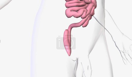 Téléchargez les photos : La chirurgie d'anastomose iléoanale permet d'enlever les parties supérieure et inférieure du gros intestin. Rendu 3D - en image libre de droit