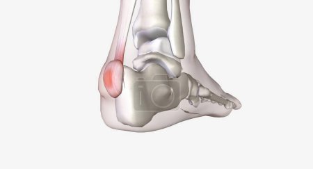Photo for Haglund's deformity is bone growth on the back of the heel 3D rendering - Royalty Free Image