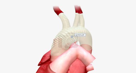 Foto de Un injerto sintético es un tubo artificial que permite que la sangre oxigenada fluya desde el corazón al resto del cuerpo. Renderizado 3D - Imagen libre de derechos