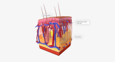 Téléchargez les photos : Angioedema is a swelling of the dermis and subcutaneous tissue.Anaphylaxis, Histamine Release and Vascular Edema 3D rendering - en image libre de droit