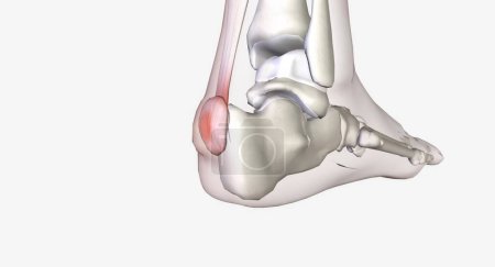 Photo for Haglund's deformity is bone growth on the back of the heel 3D rendering - Royalty Free Image