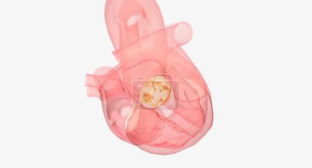 Photo for Aortic valve replacement and repair are open-heart surgical procedures to treat aortic stenosis, which is a narrowed heart valve that cannot open and close properly. 3D rendering - Royalty Free Image