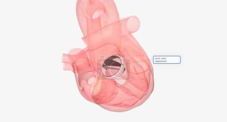Foto de La válvula aórtica dañada se puede reparar apretando el anillo alrededor de la válvula, cerrando desgarros o agujeros en la válvula, separando las cúspides de la válvula fusionada o agregando soporte a la válvula. Renderizado 3D - Imagen libre de derechos