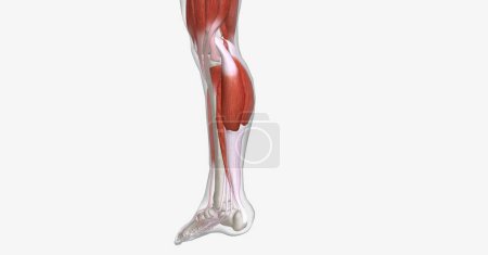 A muscle cramp is a sudden, painful, and involuntary contraction of one or more muscles. 3D rendering