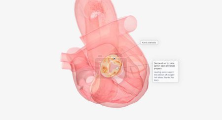 Foto de El reemplazo y reparación de la válvula aórtica son procedimientos quirúrgicos a corazón abierto para tratar la estenosis aórtica, que es una válvula cardíaca estrecha que no puede abrirse y cerrarse adecuadamente. Renderizado 3D - Imagen libre de derechos