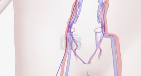 Photo for First a catheter, a thin tube, is inserted into a large vessel of the leg. The catheter is guided to the site of the aneurysm, and the stent graft will be sent along the catheter. 3D rendering - Royalty Free Image