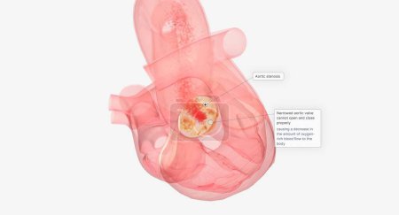 Foto de El reemplazo y reparación de la válvula aórtica son procedimientos quirúrgicos a corazón abierto para tratar la estenosis aórtica, que es una válvula cardíaca estrecha que no puede abrirse y cerrarse adecuadamente. Renderizado 3D - Imagen libre de derechos