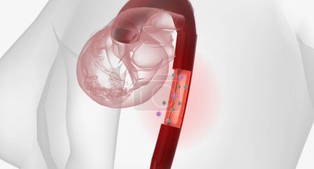 Téléchargez les photos : High volumes of lymphocytes, macrophages, and other immune cells infiltrate the inflamed aorta. 3D rendering - en image libre de droit