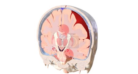 Foto de Un tipo común de hernia cerebral se caracteriza por el tejido cerebral que se mueve por debajo del pliegue medio de la dura (falx cerebri). Este tipo se llama hernia cerebral subfalcina. Renderizado 3D - Imagen libre de derechos
