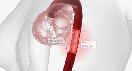 Foto de High volumes of lymphocytes, macrophages, and other immune cells infiltrate the inflamed aorta. 3D rendering - Imagen libre de derechos