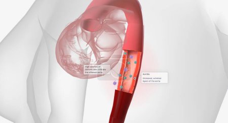 Foto de High volumes of lymphocytes, macrophages, and other immune cells infiltrate the inflamed aorta. 3D rendering - Imagen libre de derechos
