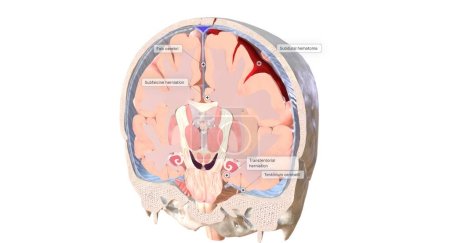 Téléchargez les photos : Un type commun d'hernie cérébrale se caractérise par le déplacement des tissus cérébraux sous le pli médian de la dure-mère (falx cerebri). Ce type est appelé une hernie cérébrale subfalcine. rendu 3D - en image libre de droit
