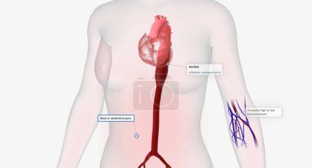Foto de Aortitis is a rare condition characterized by inflammation of the aorta. 3D rendering - Imagen libre de derechos