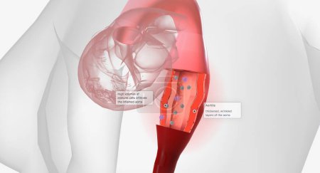 Téléchargez les photos : High volumes of lymphocytes, macrophages, and other immune cells infiltrate the inflamed aorta. 3D rendering - en image libre de droit