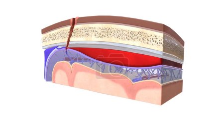 Foto de La sangre que se acumula entre la duramadre y la aracnoidea se llama hematoma subdural. Renderizado 3D - Imagen libre de derechos