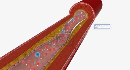 Photo for Hypercholesterolemia is a condition characterized by higher than average levels of cholesterol in the bloodstream. 3D Render - Royalty Free Image