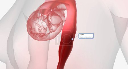 Téléchargez les photos : Aortitis is a rare condition characterized by inflammation of the aorta. 3D rendering - en image libre de droit