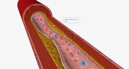 Foto de La hipercolesterolemia es una afección caracterizada por niveles más altos que el promedio de colesterol en el torrente sanguíneo. Renderizado 3D - Imagen libre de derechos