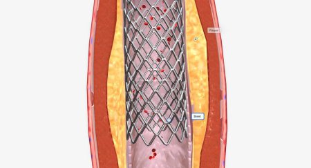 Téléchargez les photos : Une endoprothèse peut être mise en place pour prévenir le blocage à l'avenir. rendu 3D - en image libre de droit