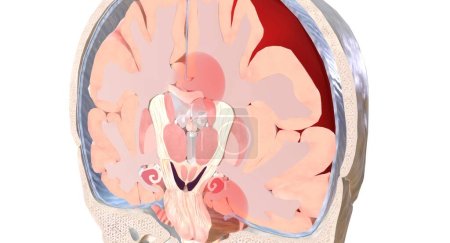 Téléchargez les photos : Un type commun d'hernie cérébrale se caractérise par le déplacement des tissus cérébraux sous le pli médian de la dure-mère (falx cerebri). Ce type est appelé une hernie cérébrale subfalcine. rendu 3D - en image libre de droit