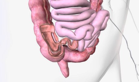 Téléchargez les photos : L'intussusception est causée par une partie de l'intestin étant tiré vers l'intérieur en lui-même. Rendu 3D - en image libre de droit