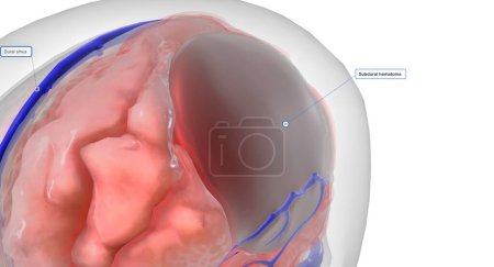 Photo for This leads to subdural bleeding (hemorrhaging). The blood that collects between the dura mater and the arachnoid mater is called a subdural hematoma. 3D rendering - Royalty Free Image