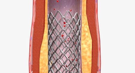 Photo for A stent may be put in place to prevent blockage in the future. 3D rendering - Royalty Free Image