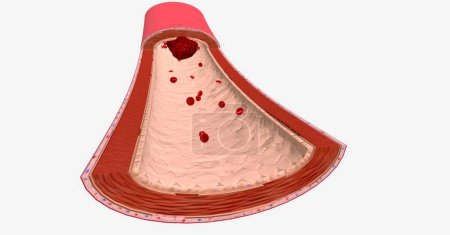 Foto de La arteriotomía produce daño deliberado al endotelio de la arteria radial. Renderizado 3D - Imagen libre de derechos
