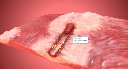 Foto de Los bloqueantes de los receptores de angiotensina II (ARA) ayudan a relajar las paredes musculares lisas de las arterias. La arteria se dilata, lo que resulta en una disminución de la presión arterial. Renderizado 3D - Imagen libre de derechos
