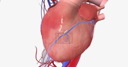Téléchargez les photos : L'ischémie myocardique est causée par une diminution du flux sanguin vers le cœur et un manque d'oxygène dans le muscle cardiaque. rendu 3D - en image libre de droit