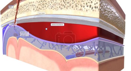 Foto de La sangre que se acumula entre la duramadre y la aracnoidea se llama hematoma subdural. Renderizado 3D - Imagen libre de derechos
